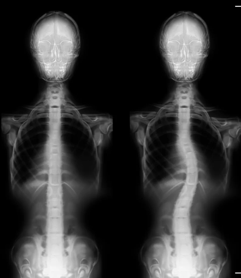 Scoliosis Port St. Lucie